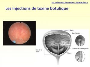 Les+injections+de+toxine+botulique